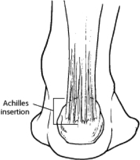 Achilles Tendon Disorders - Foot and 