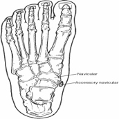 Accessory Navicular Syndrome Foot And Ankle Specialists Of Middle
