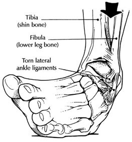 Ankle Sprain - Foot and Ankle Specialists of Middle Tennessee